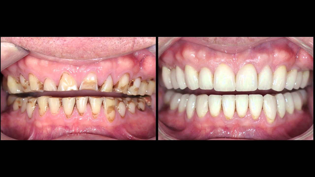 Zirconia Crown Dubai