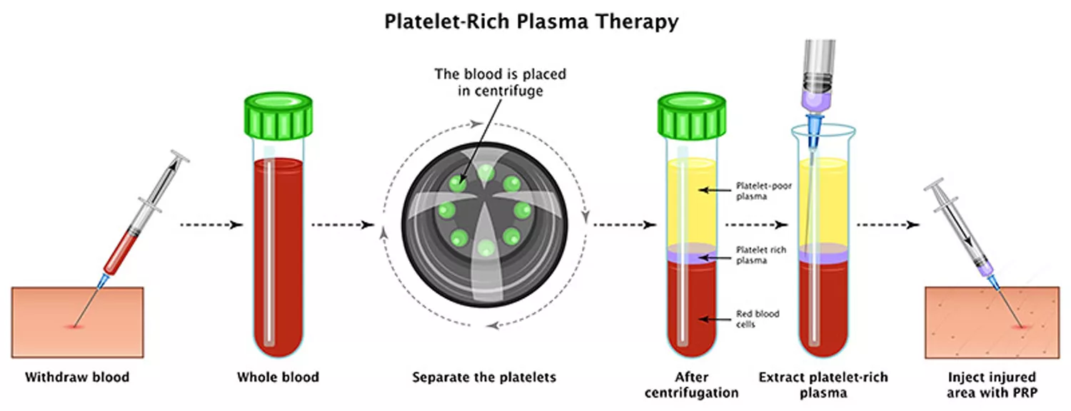 PRP Face Treatment Dubai at Cosmocare Medical Center