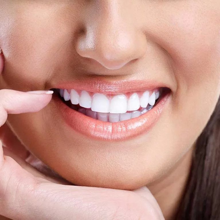 Smile Makeover with Veneers in Dubai